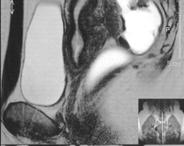 minilaparotomy Possover(2005) : LANN technique Landi (2006) : Laparoscopic nerve-sparing complete excision of DIE Deep infiltrating endometriosis - Preoperative assesment - Type of surgical treatment?