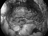 Systematic vaginal exision in cases of DIE Macroscopic lesion preoperatively detected