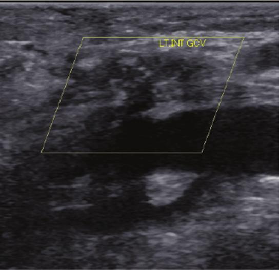 Some thrombus continued into the varicose vein via the perforating veins. The refluxing flow via the perforating veins ceased, and the varicose veins regressed.