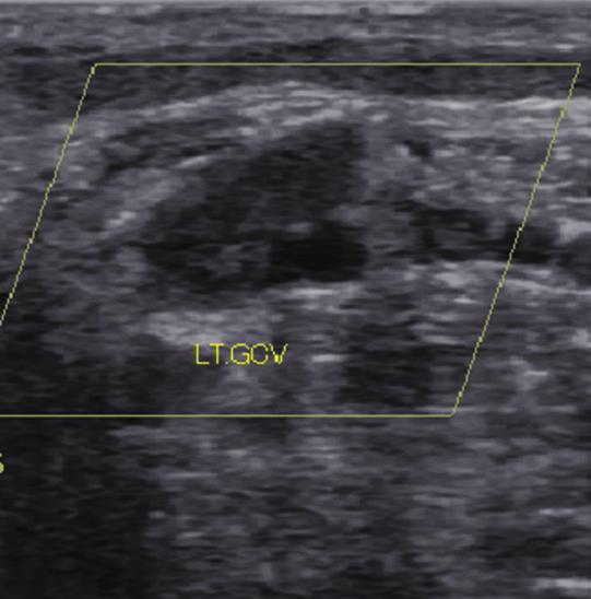 Although ultrasound images are obtained from left leg, the schematic image are of right leg in order to compare with Fig. 3.
