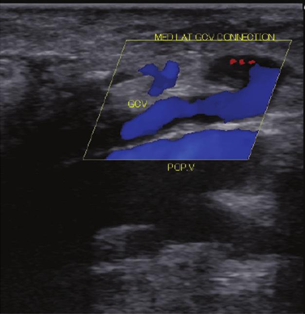 Lower left : A transverse view showing the thrombosed tributaries of a divided gastrocnemius vein in the muscle.
