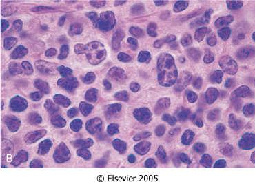 lymphoma, nasal type NK-cell leukemia V.
