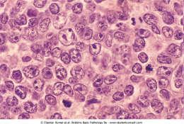 Immunophenotype The neoplastic cells closely resemble normal germinal center B cells, expressing the pan-b-cell markers CD19 and CD20, CD10 and BCL6 (transcription factor that is required for