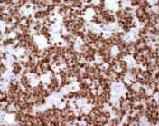 In contrast, indolent B-cell lymphomas usually produce multifocal expansion of white pulp Prognosis DLBCLs are aggressive tumors that are rapidly fatal without treatment.