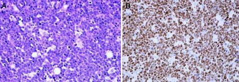 Immunophenotype These tumors of mature B cells express surface IgM, CD19, CD20, CD10, and BCL6, a phenotype consistent with a germinal