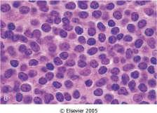 MCL is an uncommon lymphoid neoplasm that makes up about 2.5% of NHL in the United States and 7% to 9% of NHL in Europe.