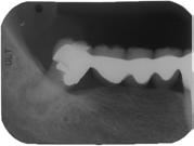 Case #1 involved an 82 year old patient who presented with a sinus tract involving the terminal abutment (tooth #32) of a long-span bridge done over 40