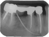 An 18 month recall radiograph shows resolution of the periapical lesion. Case #1.