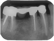 The recall radiograph, right, reveals complete healing Case #2 involved a 79 year old patient who presented with a localized swelling opposite the #30