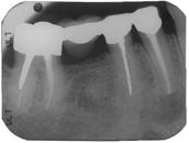 The scan identified significant periapical osteopenia and bone loss surrounding the root tip of tooth #27 and #28.