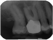 Case #3 involved a 67 year old patient who presented with palpation sensitivity involving the buccal mucosa of tooth #3.