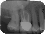 Although the pocket resolved within 3 weeks from the initiation of treatment, drainage continued into the palatal canal.