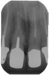 The one year recall shows almost complete osseous regeneration. Case #3. The DB canal was difficult to locate. Osseous regeneration is evident on the right recall radiograph.