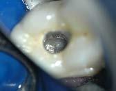 The anatomy precluded a surgical approach and the patient had prior implant failures and