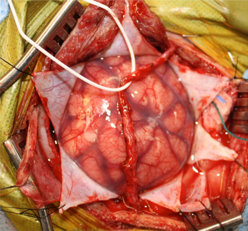 Figure 6. Intraoperative photo demonstrating a pial synangiosis being performed. The scalp is retracted, bone flap removed and dura opened in a stellate fashion exposing the brain.
