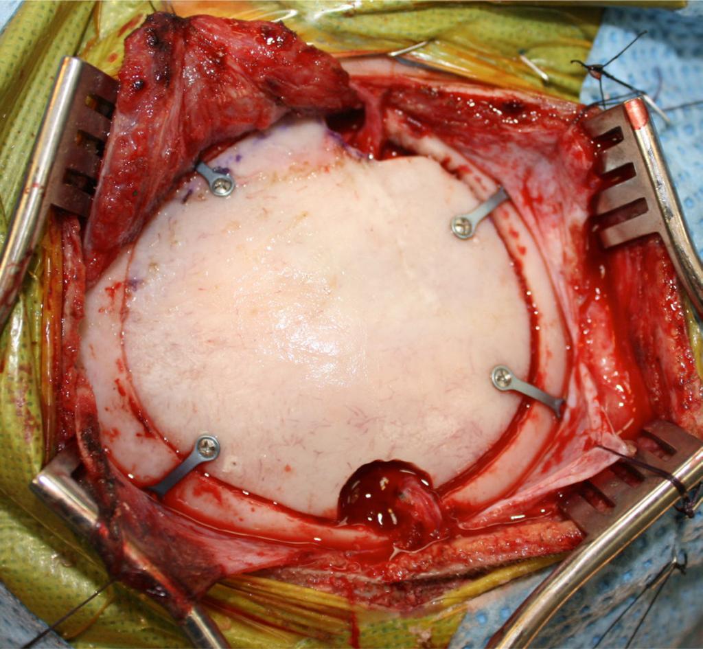 Photo provided by Dr Jodi Smith, Associate Professor of Neurological Surgery, Indiana University School of Medicine. anastomosis, both its attachments are preserved.