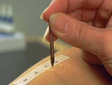 Allergy Diagnosis: Skin prick tests Emergency