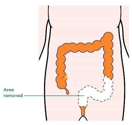 You may only have this for a short time after an operation, to allow the bowel to heal. But sometimes it may be permanent.