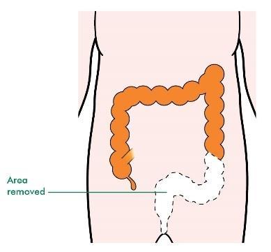 Types of operation for rectal cancer Anterior resection the doctor removes the whole rectum with the fatty tissue and lymph nodes around it.