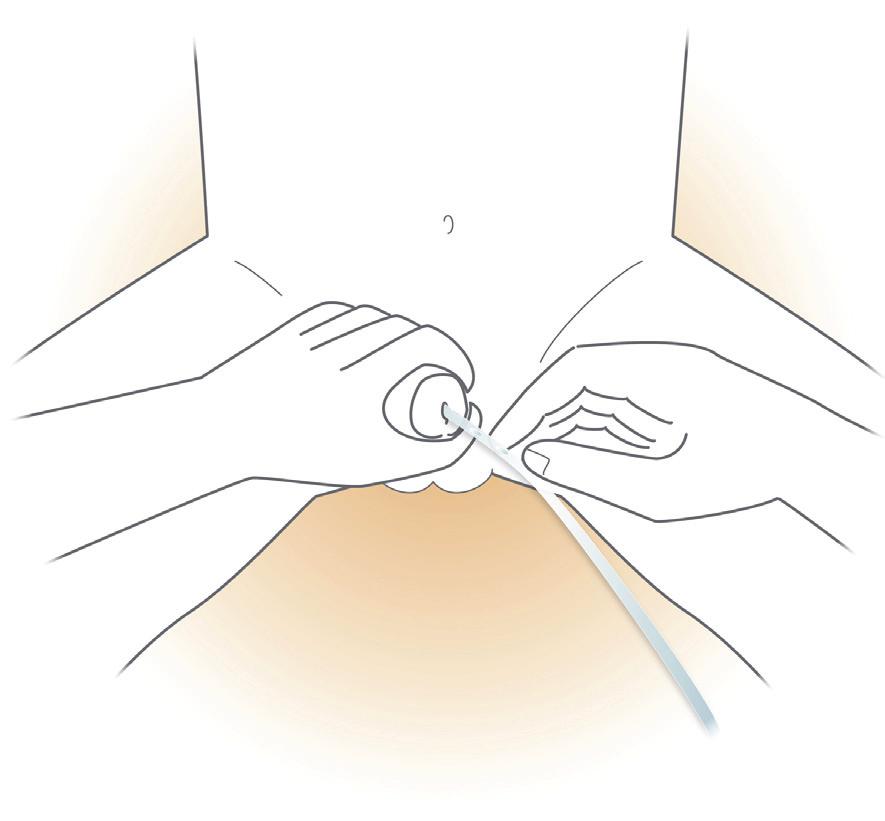 Intermittent Catheterization Instructions for Boys continued 4. Lay out the equipment so it is within easy reach. Open the water soluble lubricant and catheter package.