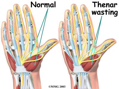 A traumatic wrist injury may cause swelling and extra pressure within the carpal tunnel.