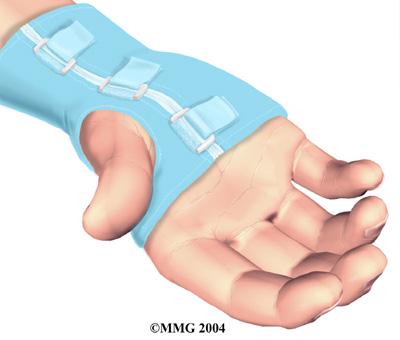 Some doctors feel this is a signal that a surgical release of the transverse carpal ligament would have a positive result.