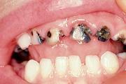 Dental Caries in the United States A Crisis For Our Children Dental caries is the
