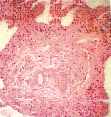 Plexiform lesion Focal proliferation