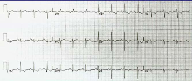 ECG RVH and R axis deviation tall R wave in V1 prominent S wave in V5 and V6 inverted T