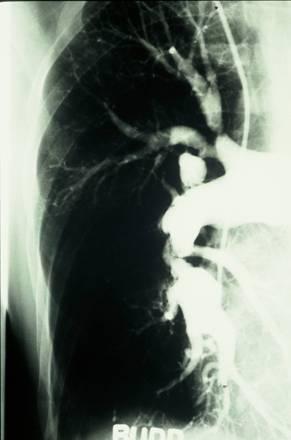 CTEPH: Pulmonary Angiography Confirms diagnosis of CTEPH in patients with PH Assess thrombus