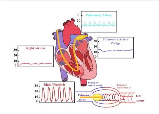 PA hypertension diagnosis via right heart catheterization From Mayo
