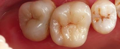 Indirect restoration on 26 and 27 after cementation and