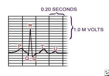 ECG Waveforms Electrocardiogram - Normal Image reprinted with