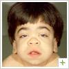 Mucopolysaccharidosis MPS III MPS III or Sanfilippo syndrome is a rare recessive syndrome Caused by an enzyme deficiency that leads