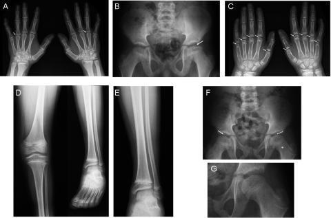 Stickler syndrome type 4 patients unaffected flattened and irregular femoral epiphyses flattenend metacarpal