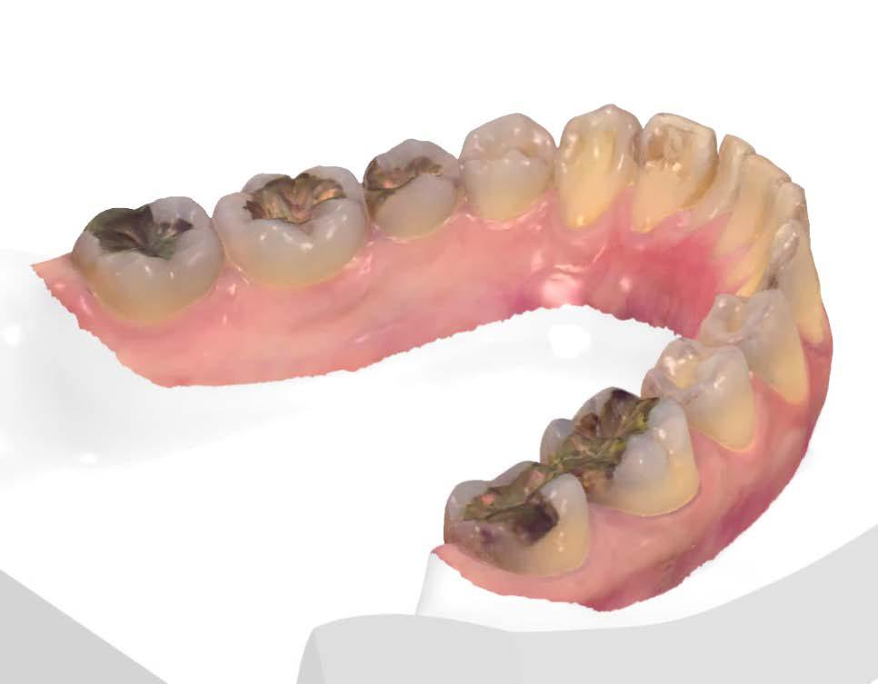 SUFFICIENT SOFT TISSUE EXTENSION Sufficient palatal soft tissue extension ensures