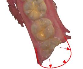 0mm clearance between two closest teeth in opposing arches (excluding distal of last present teeth) 3.
