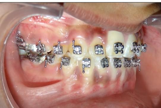 Fixed orthodontic treatment was initiated to eliminate