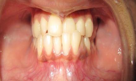 B) Orthodontic camouflage : Definitive treatment can be carried out in the permanent dentition if the skeletal discrepancy is mild and facility for dento-alveolar compensation still