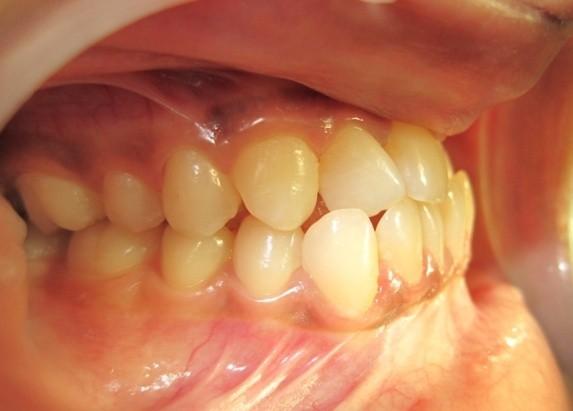 Extractions are often required in the upper arch of class III cases because of crowding; however, when attempting camouflage, lower arch extractions are also commonly required to create