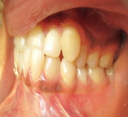 Mid-arch extractions are usually undertaken in both arches, although in adult patients a single lower incisor extraction can be considered.