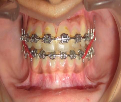 Case 2:-A 19 year female reported with chief complain of irregular placed upper front teeth and abnormal relationship between upper and lower front teeth.