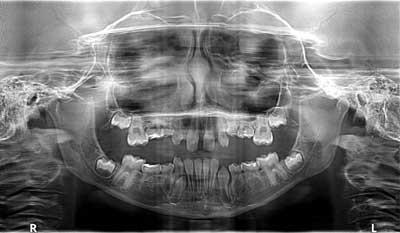 Figure 2: The panoramic film reflected the ankylosis and the fact that none of these teeth had permanent successors.