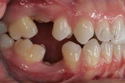 Figure 5: This 24-year-old patient had ankylosed primary second molars, and