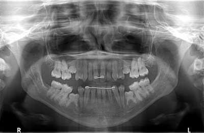 Figure 6: Since no intervention was ever suggested, she was literally watched until the teeth were completely submerged.