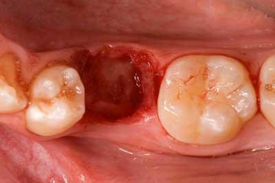 The biology In a sample of patients who are missing mandibular second premolars, Ostler (4) extracted the ankylosed teeth and followed them for a seven-year period.