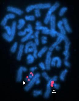 Acute Myelogenous Leukemia (AML M4): Detection of inversion of chromosome 16 by scfish probe.