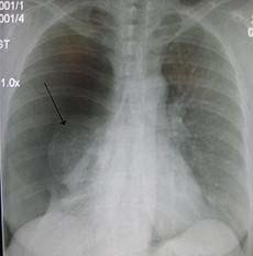 Pneumothorax Pneumothorax is a collection of air or gas in the