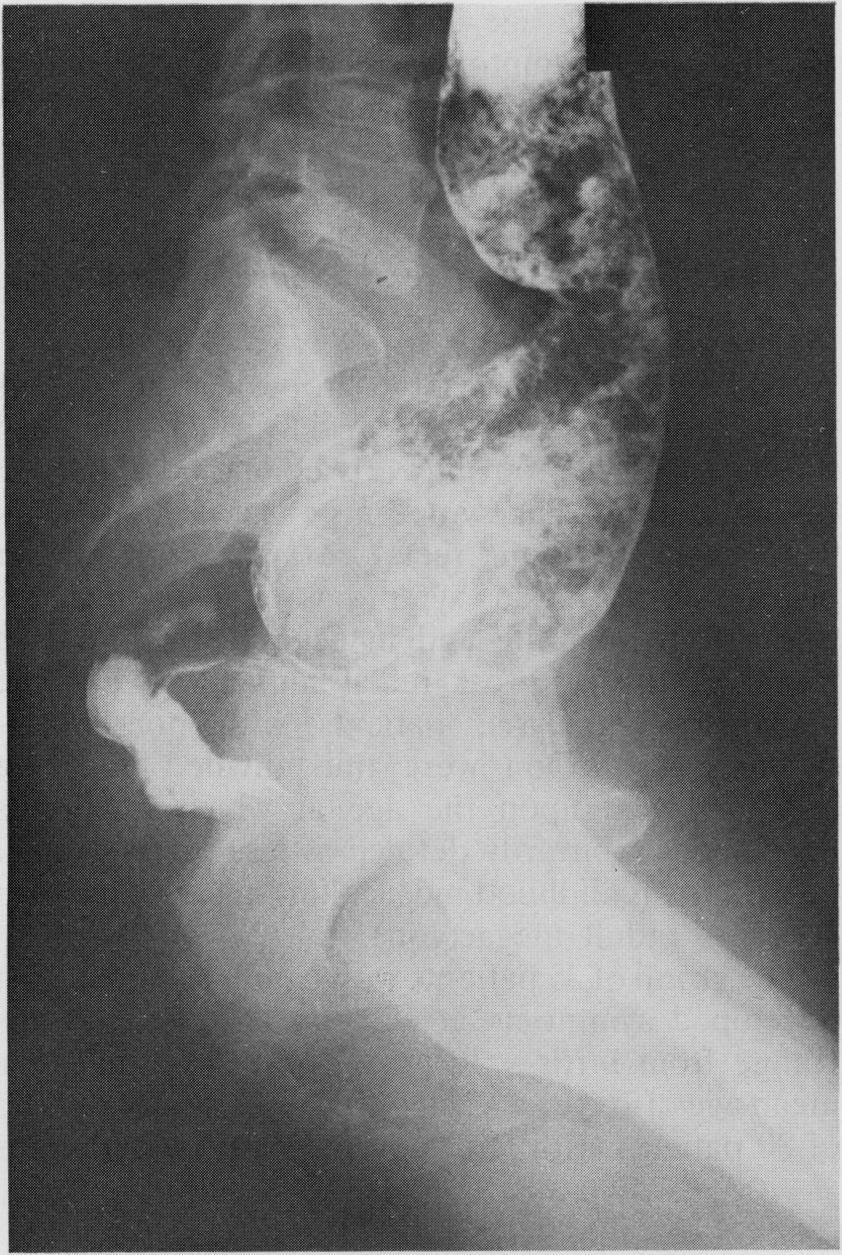 Hirschsprung's disease and idiopathic megacolon in adults and adolescents Fig. 1 Barium enema showing the typical distal narrow segment of Hirschsprung's disease.