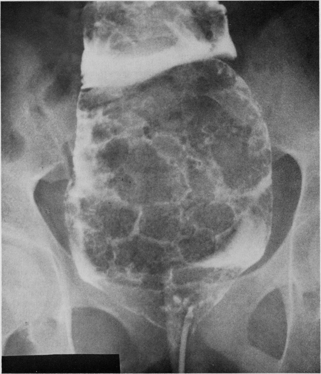 Hirschsprung's disease and idiopathic megacolon in adults and adolescents had a mean age of onset of 29 years (range 11-59 years) and presented at a mean age of 38 years (range 15-68 years).